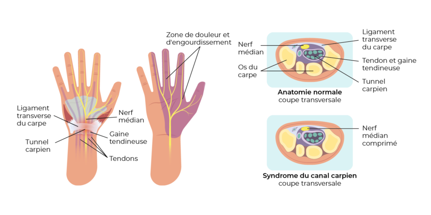 Syndrome du canal carpien – Dr Alexandru Datco
