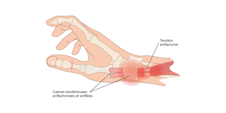 Tendinite de Quervain – Dr Alexandru Datco