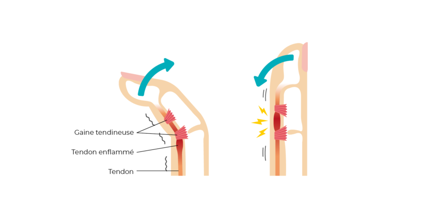 Tendinite de Quervain – Dr Alexandru Datco