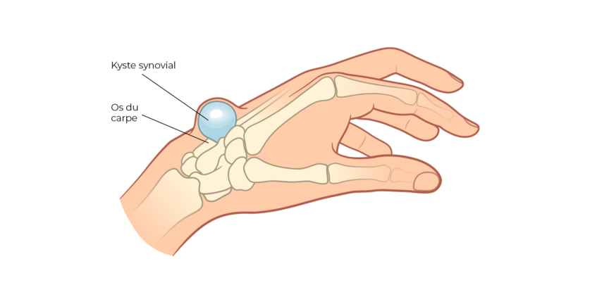 Kyste synovial – Dr Alexandru Datco