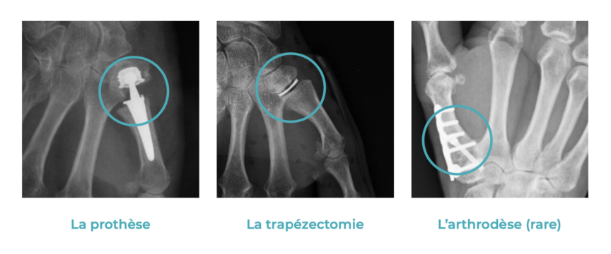 Tendinite de Quervain – Dr Alexandru Datco